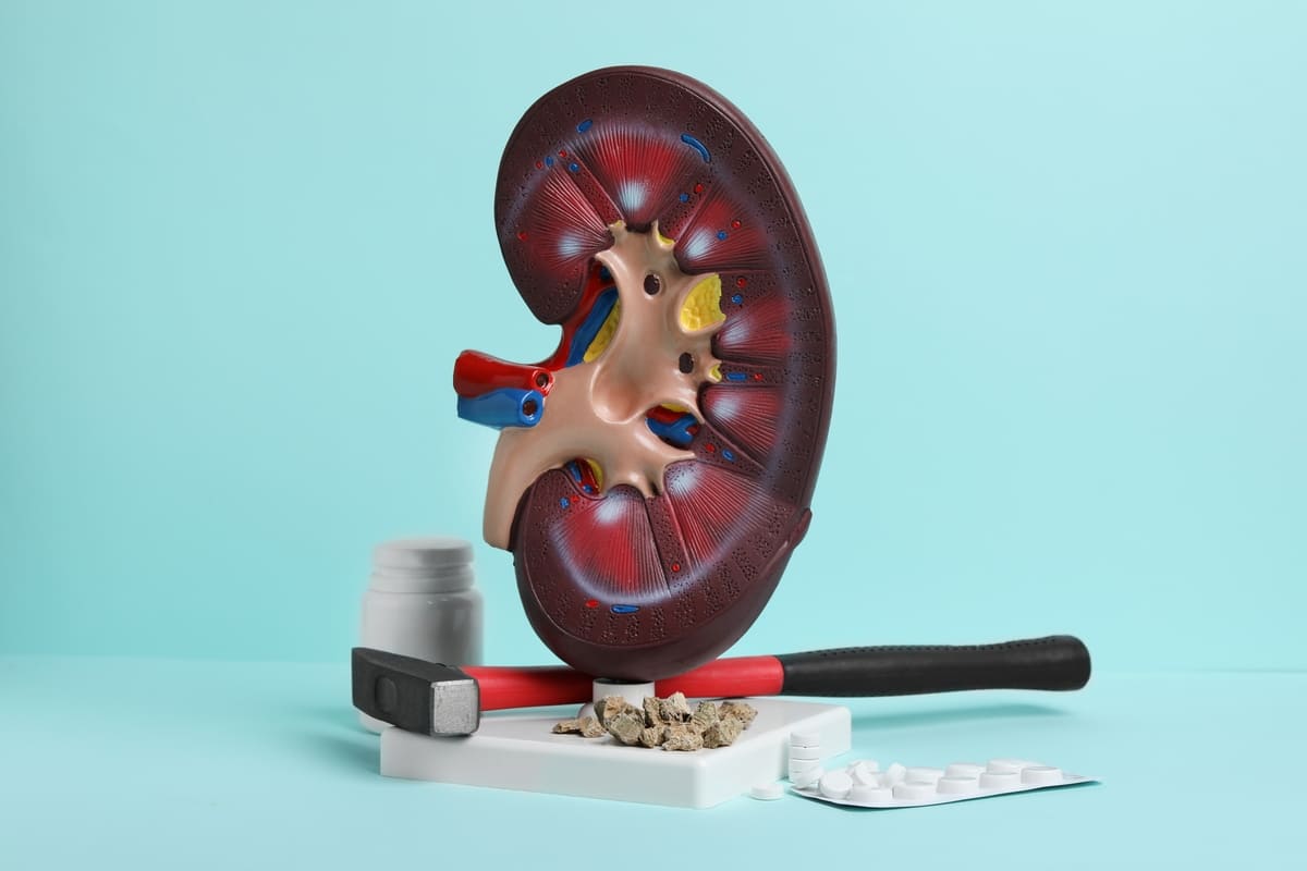 calculo-renal