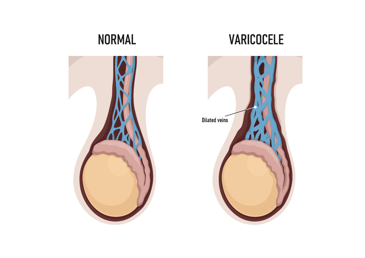 varicocele